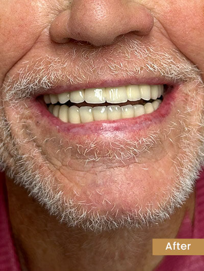 After All-on-X Treatment