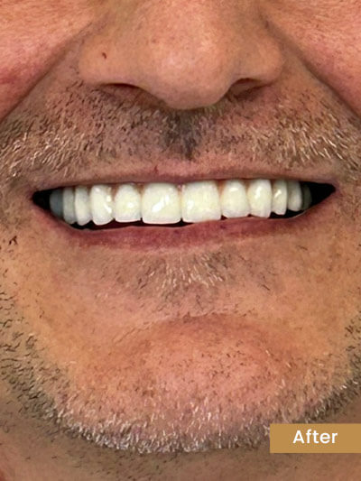 After treatment