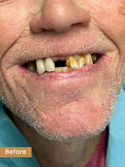 Before All-on-X Treatment