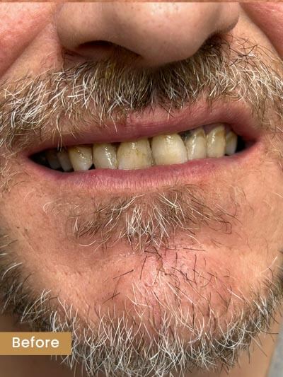 Before treatment