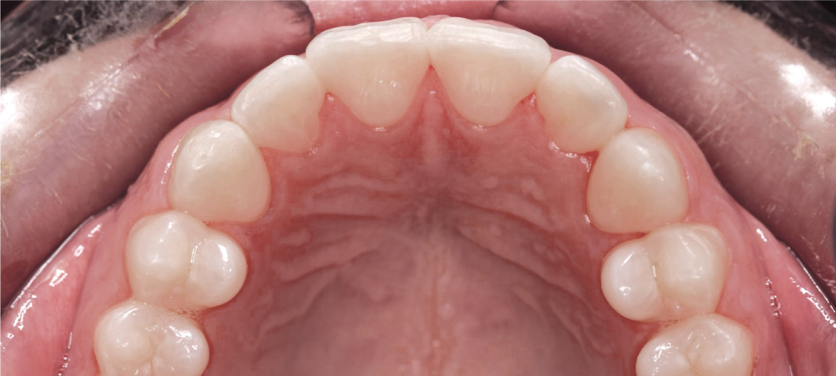 After invisible aligner treatment - straight aligned teeth