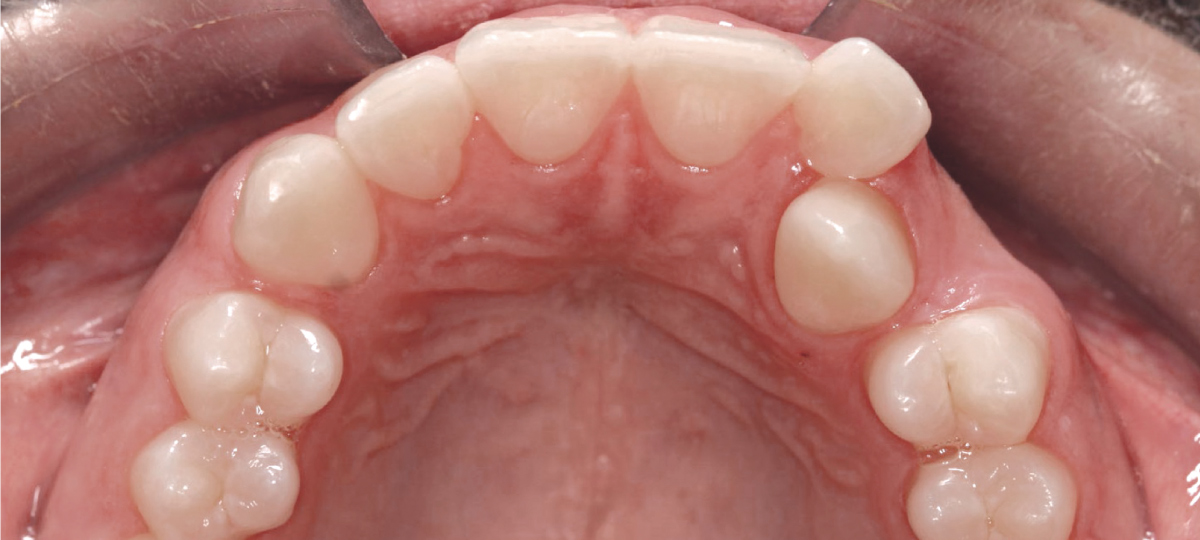 Before invisible aligner treatment - crowded teeth