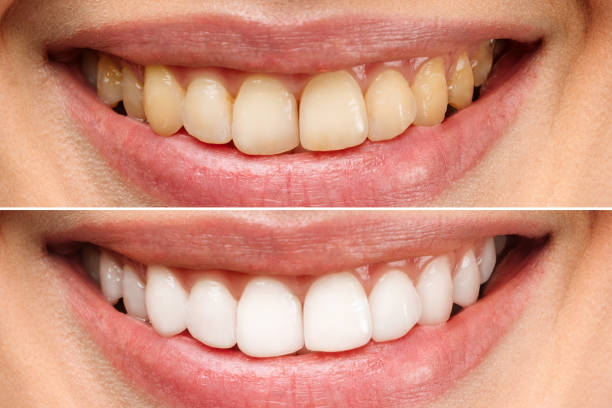 Professional Teeth Whitening Treatment