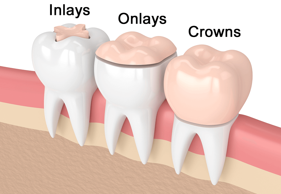 Different types of dental fillings