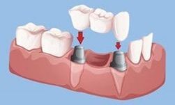 Bridge on 2 dental implants to replace multiple missing teeth