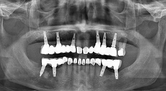 Panoramic X-ray after full upper zirconia bridge on six dental implants