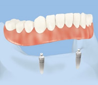 Locator (ball retained) overdenture on 2 teeth implants