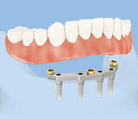 Bar retained overdenture on 4 dental implants
