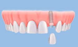 Crown on tooth implant to replace one missing tooth