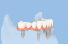 Full bridge on 6 dental implants, a perfect solution for toothless jaw
