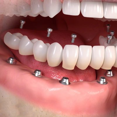 4-6 dental implants