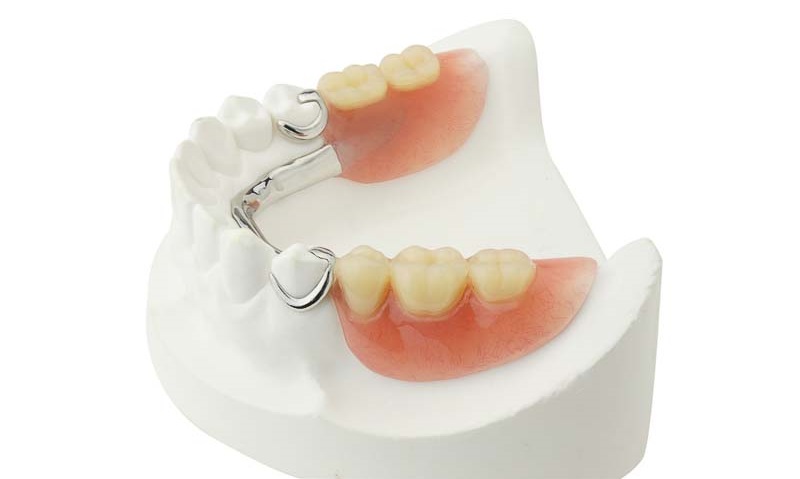 Types of partial plate dentures
