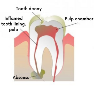A tooth in need of root canal treatment