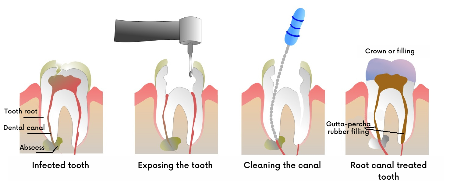 The process of painless root canal treatment