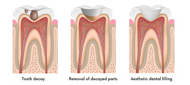 The course of aesthetic dental tooth filling