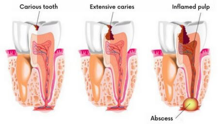 Prevention of tooth decay