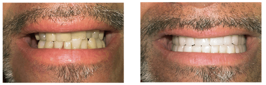 Before dental implant treatment / After zirconia bridges on teeth implants for molars and zirconia crowns on front teeth